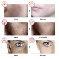 Máscara Facial LED De Rejuvenecimiento De Piel KAKUSAN Anti Acné Y Eliminación De Arrugas Terapia Fotónica USB Cargable 7 Colores - details 4