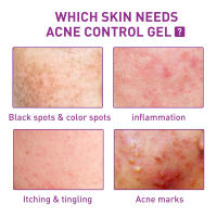 Crema aclaradora de manchas, marcas de acné, elimina el melasma, tratamiento de manchas oscuras, hidratante, opacidad, brillo de la piel, cuidado Facial - details 3