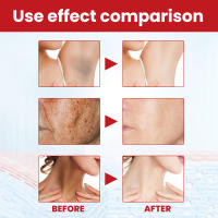 Crema Blanqueadora Efectiva para Manchas Negras Serum de Eliminación de Melasma - details 2