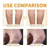 Crema para tratamiento de venas varicosas, alivia el dolor de arañas en las piernas, Vasculitis, eliminador de flebitis, ungüento reparador de vitamina K, tratamiento de relajación - details 5
