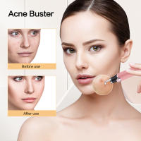 Aguja Visual inteligente para el acné, dispositivo de eliminación de acné Facial, limpieza de poros, instrumento de belleza, carga USB - details 12