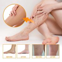 Crema para tratamiento de venas varicosas, alivia el dolor de arañas en las piernas, Vasculitis, eliminador de flebitis, ungüento reparador de vitamina K, tratamiento de relajación - details 9