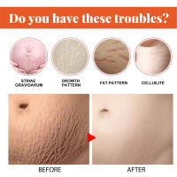 Crema que desaparece para estrías, crema reparadora antiarrugas, antienvejecimiento, tratamiento de estrías para mujeres embarazadas, crema con vitamina E para el cuidado de la piel, 50g - details 5