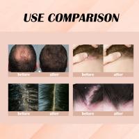 Esencia para tratamiento del cuero cabelludo, tratamiento anticaspa para psoriasis, alivia la descamación, la picazón, potenciador de folículos, suero nutritivo para el cabello - details 8