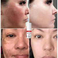 Crema Blanqueadora Efectiva para Manchas Negras Serum de Eliminación de Melasma - details 9