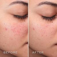 Medik8 Press & Clear 150ml Tónico Exfoliante 2% BHA - details 0