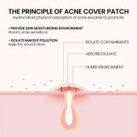 Parches Antipicas Para Acne Tratamiento Hidratante De Parches Impermeables Eliminador De Acne Herramienta Para Manchas De La Piel Cuidado Facial - details 5