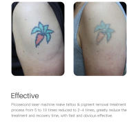 Láser Picosegundo Para Eliminación De Tatuajes Máquina De Luz Azul/Roja Para Eliminación De Manchas De Pigmento Y Arrugas - details 10
