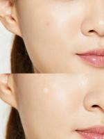 Parches Anti Acné COSRX Acne Pimple Master Patch - details 0