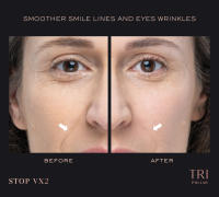 TRIPOLLAR STOP VX2 Dispositivo inteligente facial - details 1