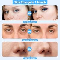 Máquina De Diamante Microdermabrasión Mejorada Para Eliminación De Quistes Profesional Limpieza Facial Profunda Dispositivo De Cuidado De La Piel Para Uso Doméstico - details 7