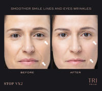 TRIPOLLAR STOP VX2 Dispositivo inteligente facial - details 0