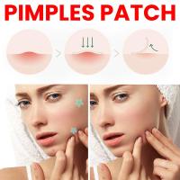 200pcs Parches De Estrella Para Acné Invisibles Eliminador De Manchas De La Piel Hidratante Y Aclarador Para El Rostro Herramientas De Belleza Y Cuidado De La Piel - details 11