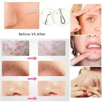Kit Profesional De 5 Piezas Para Extraer Comedones Y Negros Con Pinzas Curvadas De Acero Inoxidable Herramientas Para Puntos Negros Y Acné - details 2