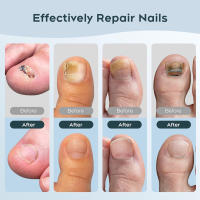 Dispositivo Láser Para El Tratamiento De Uñas Fungosas Nuevo Para Uso Doméstico Curación De Uñas Del Pie Y De Las Manos Anti-Infección De Paronychia Y Onychomycosis - details 6