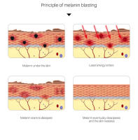Láser Picosegundo Para Eliminación De Tatuajes Máquina De Luz Azul/Roja Para Eliminación De Manchas De Pigmento Y Arrugas - details 7