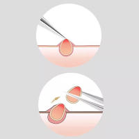 Herramienta De Eliminación De Acné Con Puntos Negros Y Quistes Herramienta De Extracción De Comedones Y Limpieza De Poros Con Agujas Para Limpiar La Cara - details 9