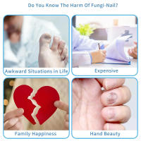 Dispositivo Láser Para El Tratamiento De Uñas Fungosas Nuevo Para Uso Doméstico Curación De Uñas Del Pie Y De Las Manos Anti-Infección De Paronychia Y Onychomycosis - details 2