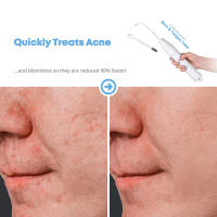 Máquina de Belleza Facial de Alta Frecuencia Vara de Electroterapia para Cuidado de la Piel de Spa - details 6