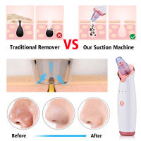 Limpieza Facial Eléctrica Remover De Puntos Negros Y Acné Herramienta De Limpieza Profunda Para Rostro Y Nariz Recargable - details 4