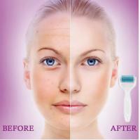Rodillo facial con microagujas - details 2
