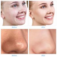 Máquina De Diamante Microdermabrasión Mejorada Para Eliminación De Quistes Profesional Limpieza Facial Profunda Dispositivo De Cuidado De La Piel Para Uso Doméstico - details 10