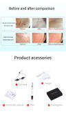 Láser Picosegundo Pluma Roja Azul Terapia De Luz Para Eliminar Tatuajes Marcas De Acné Vello Exceso Arrugas Manchas En Piel Oscuro Dispositivo De Belleza Portátil - details 6
