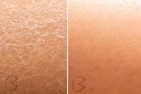 BEAUTIFLY - B-Derma Ice Pro Dispositivo de Limpieza Facial Profesional 9 en 1 – Microdermoabrasión con Luz LED, Lifting por Vacío, Compresas Frías/Calientes y 6 Cabezas Intercambiables - details 0