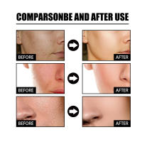 La esencia facial de niacina EELHOE atenúa las marcas del acné, hidrata, reduce los poros, blanquea la piel y embellece la piel. - details 8