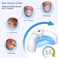 Dispositivo Láser KTS Para El Tratamiento De Hongos En Uñas De Los Pies Y Manos 12x470nm 6x910nm Con Pantalla De Tiempo 2000mA Portátil Y De Fácil Uso - details 3