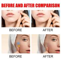 200pcs Parches De Reparación Para Acné Facial Cuidado De La Piel Elimina Manchas De Espinillas Y Acné Parches Para Cubrir Y Reparar - details 7