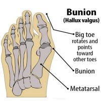 Corrector de juanete superelástico, Protector para prevenir Hallux Valgus, para el cuidado diario de la salud, 2 piezas - details 4