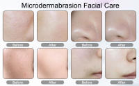 Máquina De Dermaplanificación Microdiamante 3 En 1 Para Cuidado De La Piel Facial Eliminación De Vello Caspa Y Acné Herramienta De Vacío Y Spraying - details 6