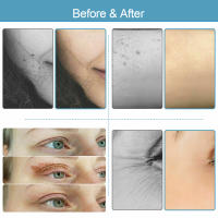 Plasma Pen Profesional Fibroblast Eletrónico Levantamiento De Párpados Quema De Manchas Arrugas Anti-Envejecimiento Belleza Rejuvenecimiento De Piel Eliminador De Vello Corporal - details 11