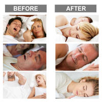 Protector De Sueño South Moon Anti Snore Piecesa Para Dormir Parar El Ronquido Dispositivo Para La Calidad Del Sueño Bruxismo Mordida En Descanso - details 9