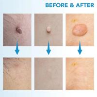 Kit De Eliminación De Marcas De Piel Quedonc Herramienta Effeciva Para Eliminar Marcas De Piel De 4mm a 9mm Dispositivo Facil De Uso Para Cuidado De La Piel Del Rostro - details 0
