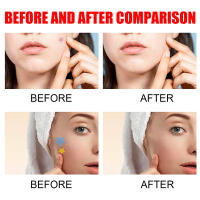 Parches Antipicas Para Acne Tratamiento Hidratante De Parches Impermeables Eliminador De Acne Herramienta Para Manchas De La Piel Cuidado Facial - details 6