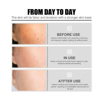 La esencia facial de niacina EELHOE atenúa las marcas del acné, hidrata, reduce los poros, blanquea la piel y embellece la piel. - details 1