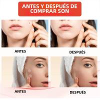 240Pcs Parches De Acné De Alta Gama Forma De Corazón Y Estrella Para Cubrir Erupciones Cutáneas Y Puntos Negros Parches Hidratantes Para El Rostro - details 5