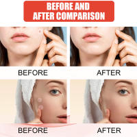 Parches Para Acné Y Marcas De Puntos De Cuidado Facial 144pcs Invisibles Tratamiento De Acné Y Cicatrices De Puntos Para Belleza - details 8