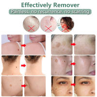 Laser Plasmático Para Eliminar Manchas Y Verrugas En La Piel Dispositivo De Remoción De Acné Y Puntos Negros Para El Rostro - details 8