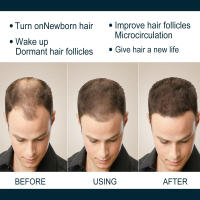 1 juego de suero para el crecimiento del cabello, tratamiento fortalecedor del crecimiento del cabello para hombres, tratamiento fortalecedor del crecimiento del cabello para el adelgazamiento del cabello y la caída del cabello - details 9