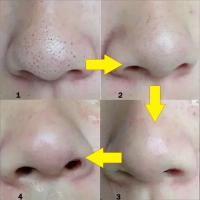10-100pcs Parches Para Puntos Negros Y Acné Profundo Limpieza Nasal Adhesivos De Puntos De La Cara Máscara De Nariz Para Eliminar Puntos Negros Y Acné - details 2
