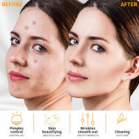Lámpara De Masaje Facial De Alta Frecuencia Rejuvenecimiento De La Piel Terapia Neón+Argo Con Tubo De Vidrio Anti-Edad Reducción De Arrugas Eliminador De Acné - details 6