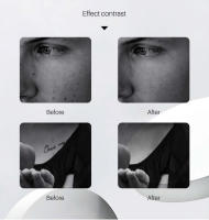 Láser Picosegundo Para Eliminación De Tatuajes Máquina De Luz Azul/Roja Para Eliminación De Manchas De Pigmento Y Arrugas - details 9