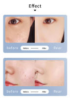 Lápiz De Eliminación De Tatuajes Láser Beemyi Blue Light Picosecond Pen Cuidado De La Belleza Para El Rostro Eliminación De Manchas Y Acné - details 5