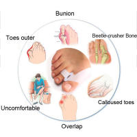 Almohadilla De Silicona Para Dedos Del Pie Corrector De Dedos Del Pie Protector De Valgus Ajustador De Bigote Alivio Del Dolor De Pies - details 2