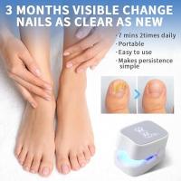 Dispositivo de lámpara de limpieza de hongos de uñas, solución de uso eficaz para uñas gruesas y decoloradas dañadas, para uso doméstico, eliminador de hongos de uñas recargable - details 0