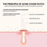 200pcs Parches De Reparación Para Acné Facial Cuidado De La Piel Elimina Manchas De Espinillas Y Acné Parches Para Cubrir Y Reparar - details 4