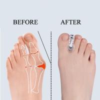 Corrector De Ballena Hallux Valgus 2pcs Separador De Dedos Del Pie Corregidor De Dedos Del Pie Herramienta De Cuidado Del Pie Silicone - details 1